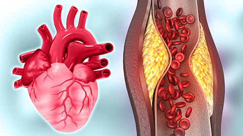 A diagram of a heart with blockage