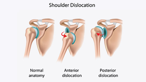 Shoulder dislocation