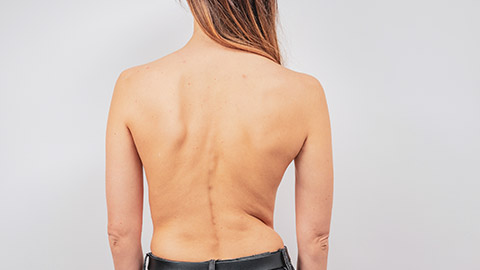 A rear view of a person with scoliosis