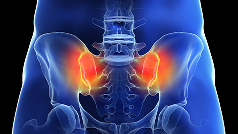 A sacroiliac joint inflammation