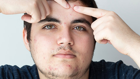 A teenager with a pimple on his face