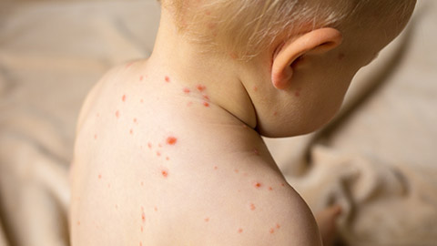 A child with chicken pox