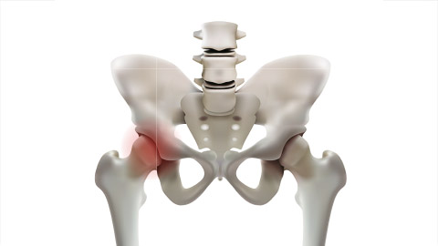 Arthritis of the hip joint on a white background. 3d vector illustration