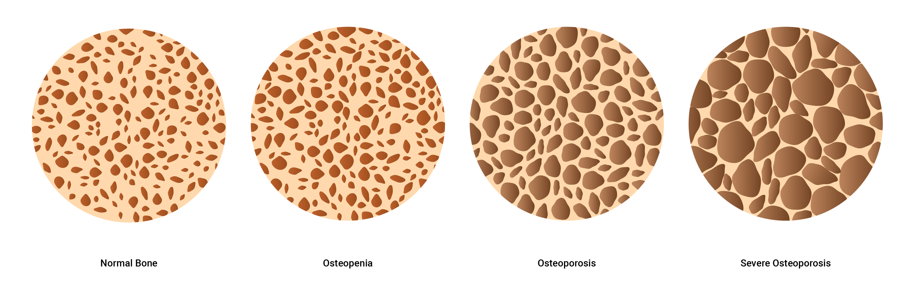 Diagram of stages of osteoporosis