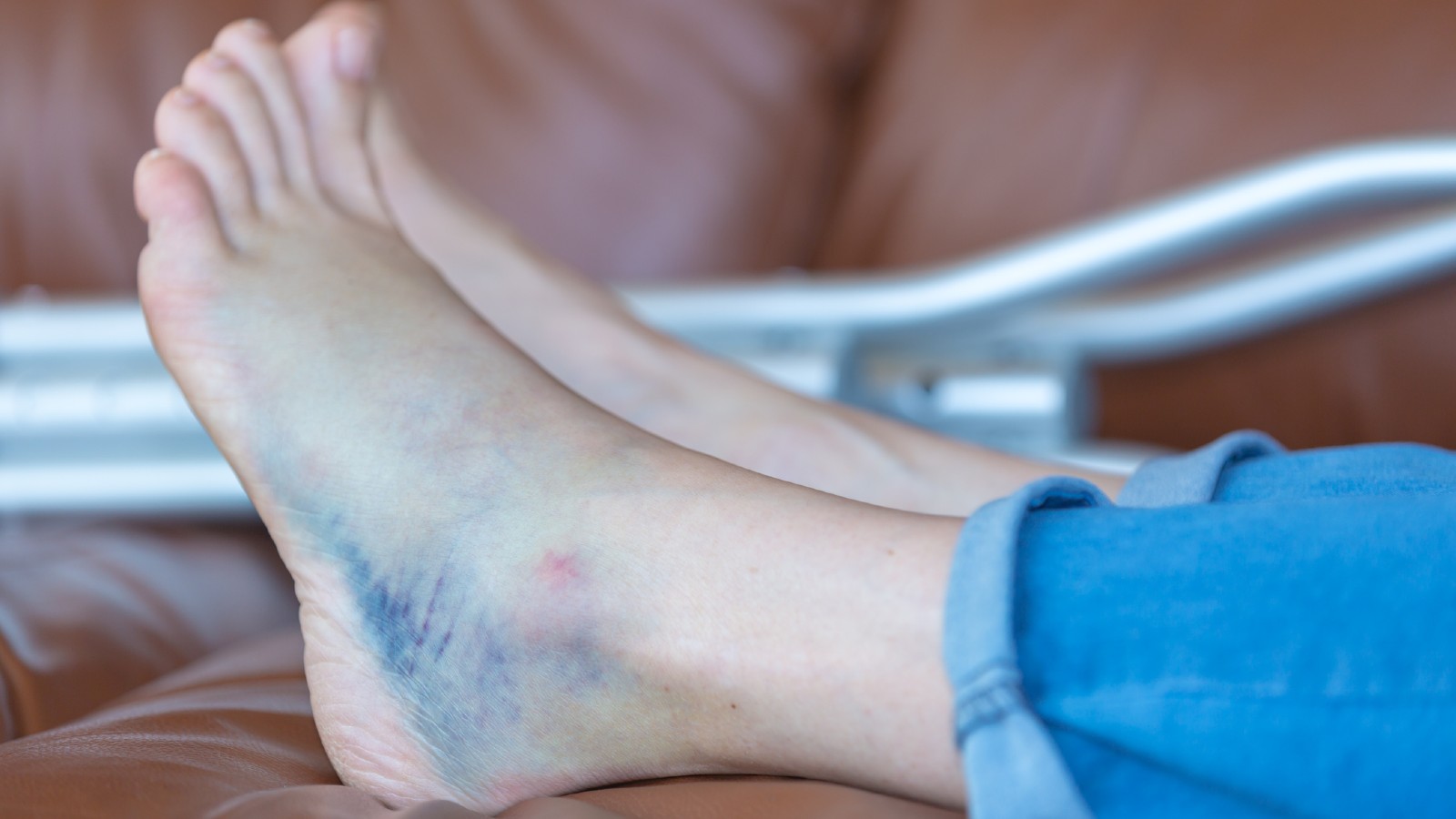 Woman with a sprained ankle and bruising