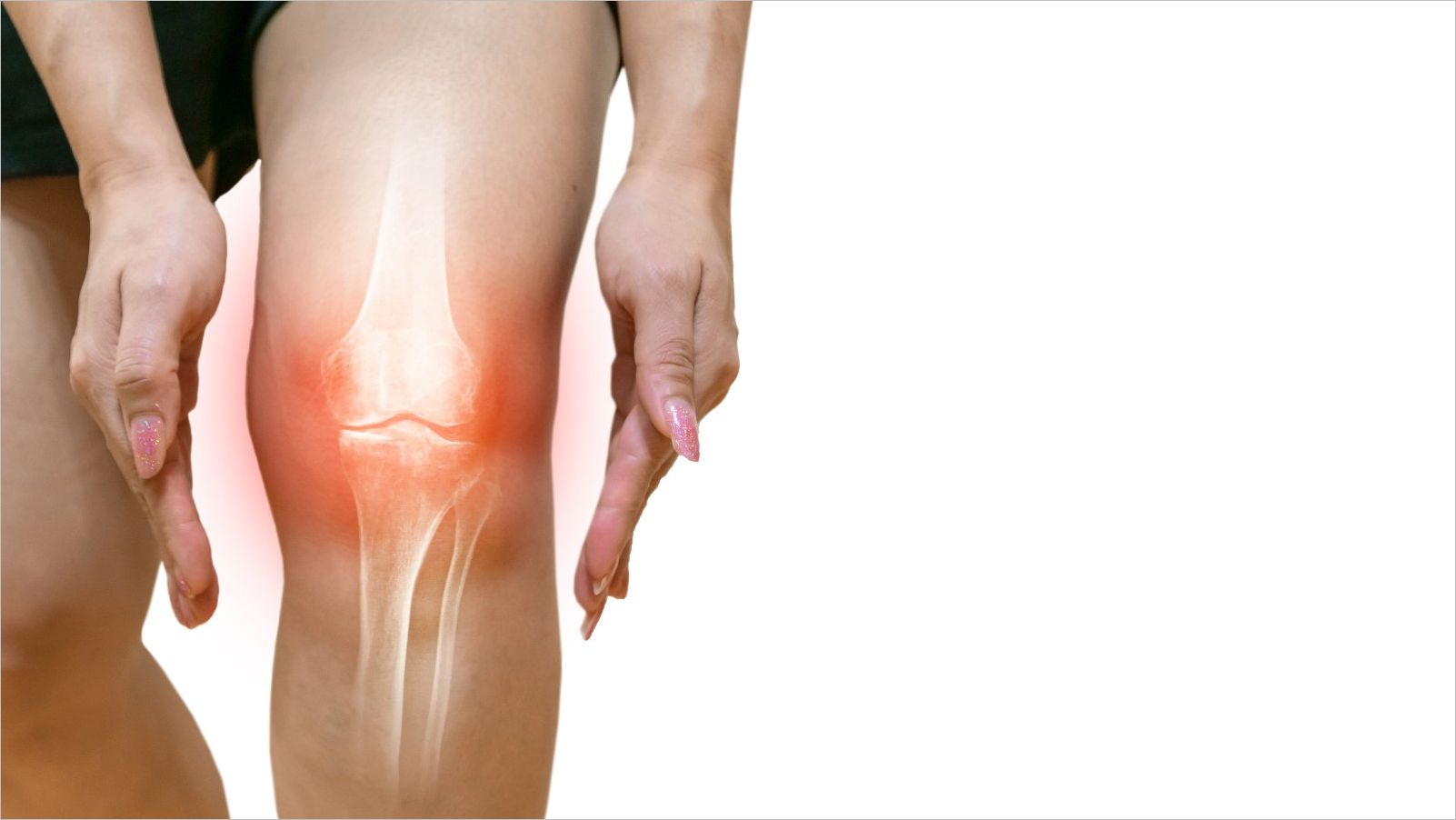 Close up internal image of a woman's knee showing inflammed joints experienced with osteoarthritis