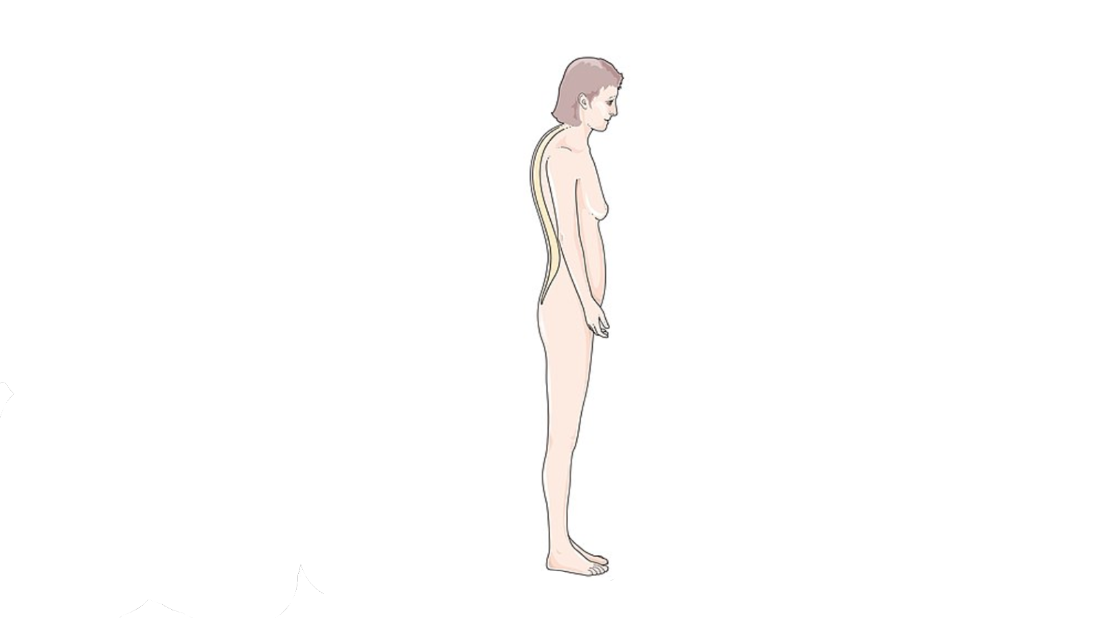 Diagram of person with Kyphosis