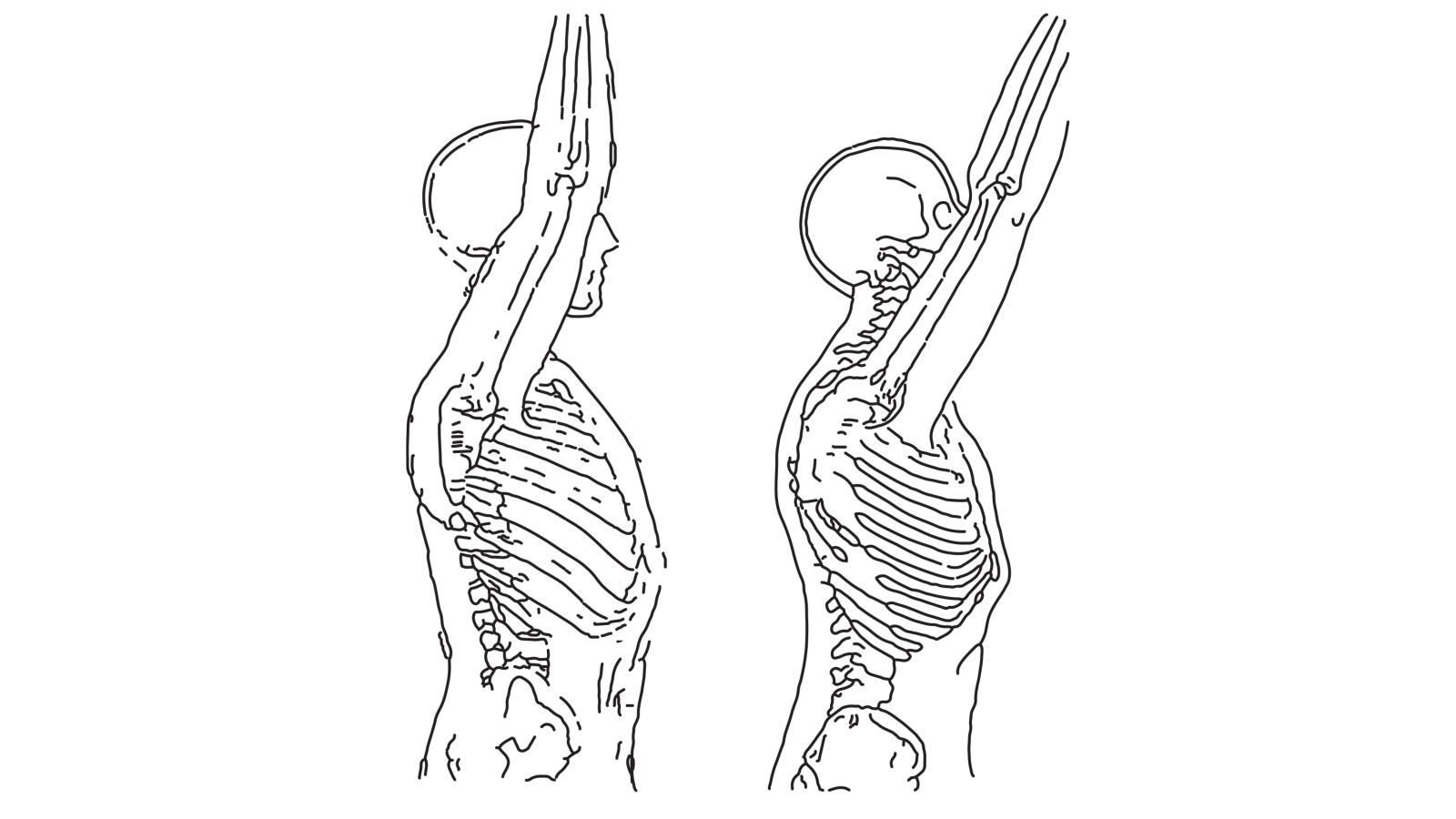 Diagram showing Anterior Tipping of the Scapula, two figures with skeleton showing, one normal with arm fully raised, one with Anterior Tipping and unable to fully raise arm